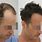 Cost of Hair Transplant