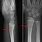 Distal Radial Metaphysis Fracture
