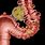 Diverticulitis Abscess Drainage