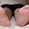 Dry Skin in Feet