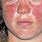 Early Lupus Skin Rash