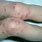 Eczema Bacterial Infection