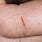 Eczema Cracked Skin