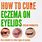 Eczema On Eyelids Treatment