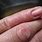 Eczema On FingerTips