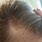 Eczema in Hair Scalp