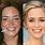 Emily Blunt Teeth Before and After