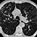 Emphysema Lung CT Scan