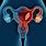 Endometrial Tumor