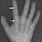 Epithesis Finger