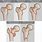 Femoral Head Fracture Types