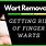 Finger Wart Removal