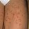 Folliculitis On Thighs