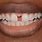 Gap Between Front Teeth