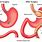 Gastric Bypass Illustration