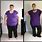 Gastric Sleeve Surgery Before After