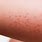 Gluten Rash On Arms