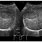 HCC Liver Ultrasound