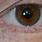 HPV On Eyelid
