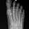 Hammer Toe X-ray