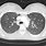 Histoplasmosis Lung CT