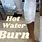 Hot Water Burn