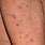 How Does Scabies Look Like