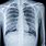 Human Chest X-Ray