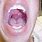 Inflamed Uvula