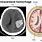 Intracerebral Hemorrhagic Stroke