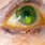 Keratitis Eye