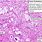 Krukenberg Tumor Histology