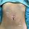 Laparoscopic Ovarian Cyst Removal