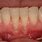 Lower Teeth Gum Recession