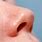 Lump Inside Nose