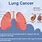 Lung Cancer Diagram