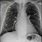 Lung Cancer X-ray Look Like