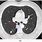 Lung Nodule On CT