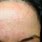 Lupus Forehead Rash