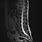 MRI Scan for Spine