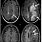 MS Brain Scan Images