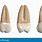 Maxillary Third Molar