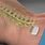 Medtronic Spinal Cord Stimulator Implant