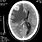 Meningioma CT Brain