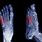 Metatarsal Fracture Left Foot