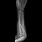 Monteggia Fracture-Dislocation