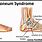 OS Peroneum Syndrome Surgery