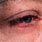 Ocular Rosacea Blepharitis