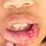 Oral Cancer Inside Lip