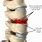 Osteophytes On Spine